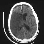 Ischemic stroke